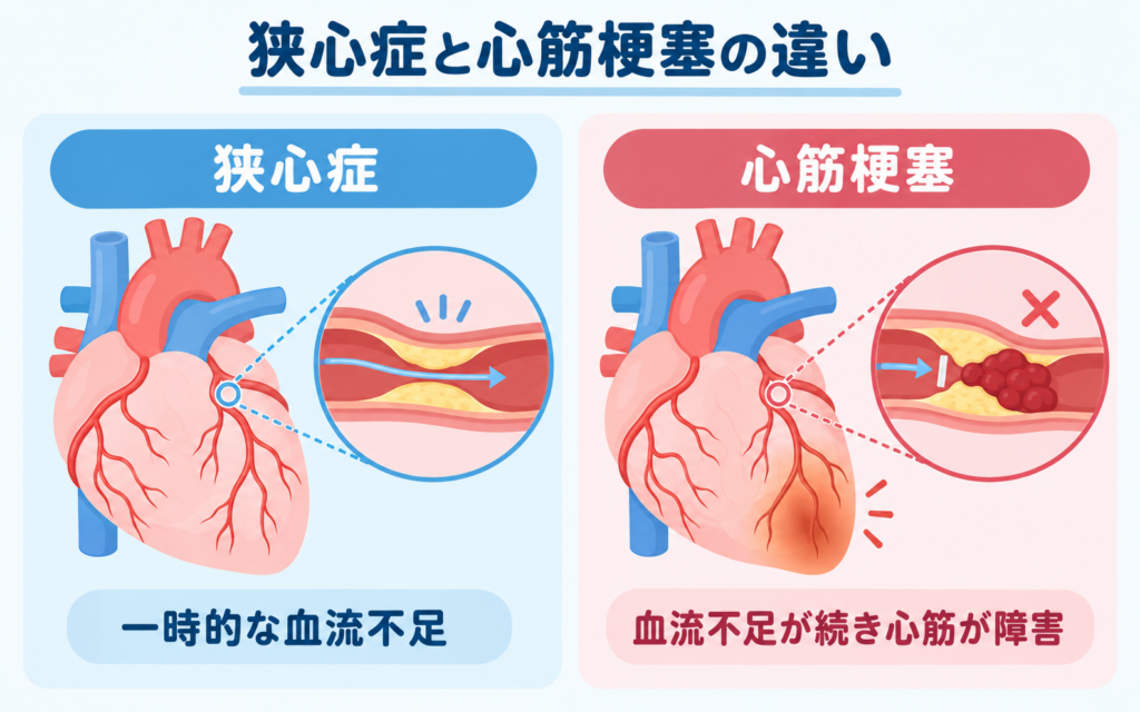 狭心症と心筋梗塞の違いを示す図。狭心症では冠動脈が狭くなり一時的に血流が不足し、心筋梗塞では血栓によって冠動脈の血流が大きく低下または途絶し、心筋が障害される。