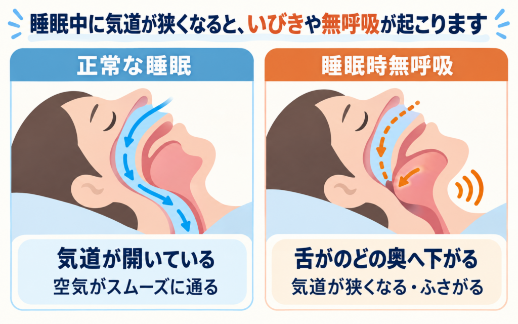 正常な睡眠と睡眠時無呼吸の気道を左右で比較した断面イラスト。正常では気道が開いて空気がスムーズに通り、睡眠時無呼吸では舌がのどの奥へ下がって気道が狭くなる・ふさがる様子を示す